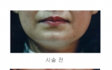 이중턱1회시술 …