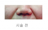 팔자주름1회시…