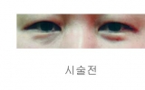 눈밑지방시술 …
