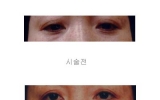 눈꺼풀쳐짐시…
