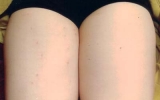 허벅지 시술 치…