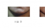 약물주입부작…