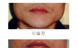 사각턱 치료사…