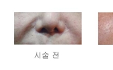 셩형수술부작…