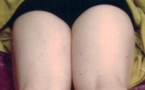 다리전체 치료…