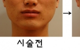 사각턱 치료사…